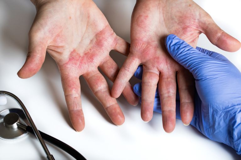 Dermatite e Dermatite Atópica: Cuidados e Tratamentos